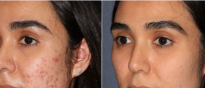 Elixir - How Microneedling