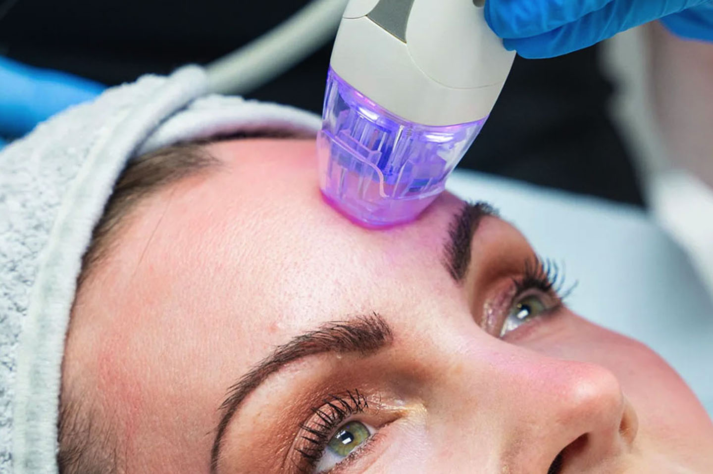 Elixir-Wellness-Center-Micro-needling