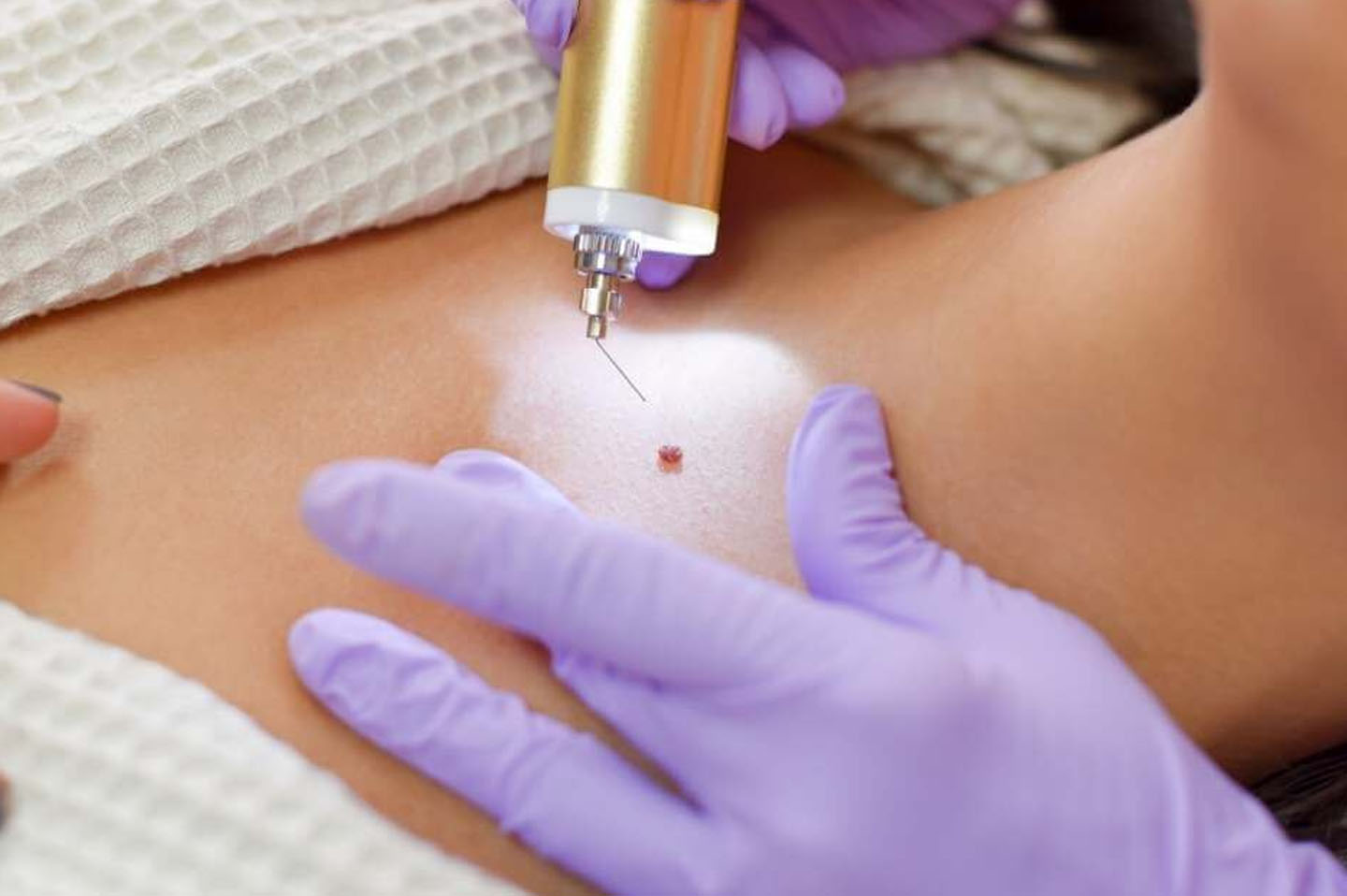 Elixir-Wellness-Center-Wort removal treatment