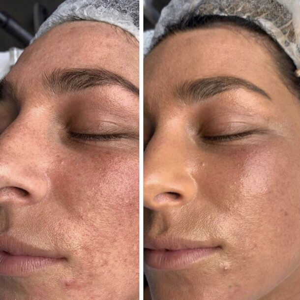 Elixir-Wellness-Center-BB Glow-Treatment