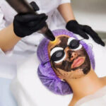 Elixir-Wellness-Center-Carbon peel treatment