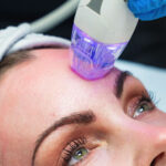 Elixir-Wellness-Center-Micro-needling