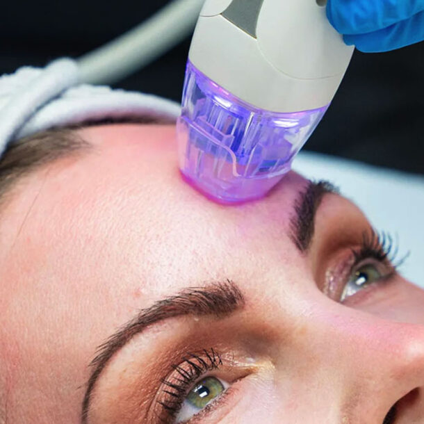 Elixir-Wellness-Center-Micro-needling