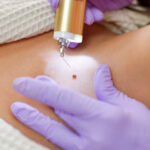 Elixir-Wellness-Center-Wort removal treatment