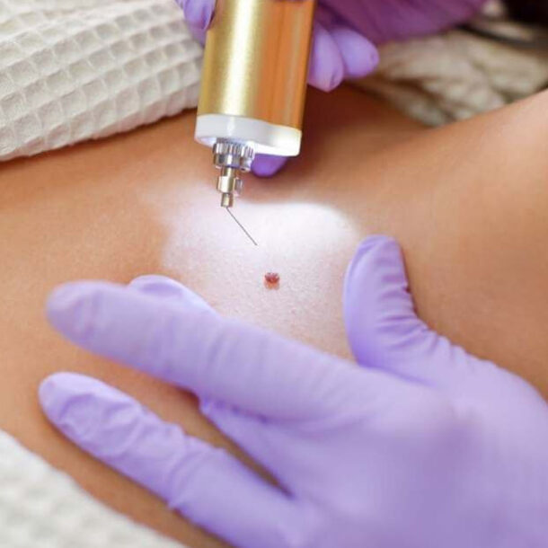Elixir-Wellness-Center-Wort removal treatment